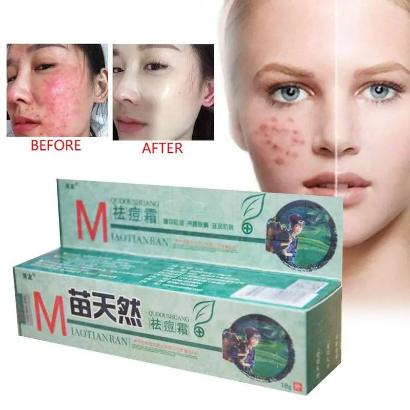 Crème Anti-Acariens Naturelle Germicide Hydratante - Traitement Acné Peau Sensible Soin Visage