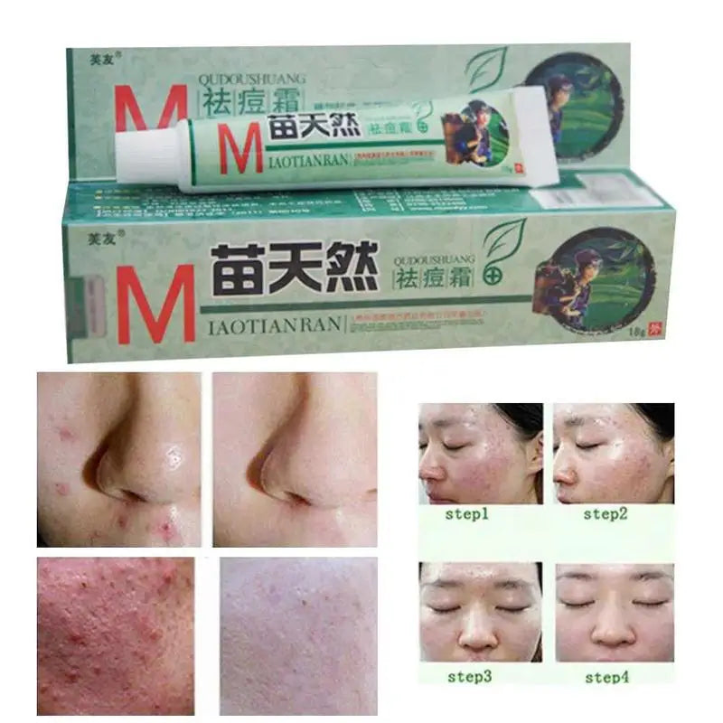 Crème Anti-Acariens Naturelle Germicide Hydratante - Traitement Acné Peau Sensible Soin Visage