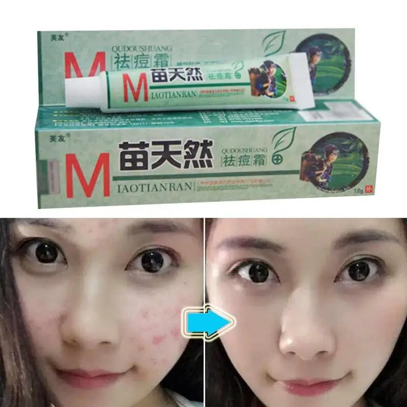Crème Anti-Acariens Naturelle Germicide Hydratante - Traitement Acné Peau Sensible Soin Visage