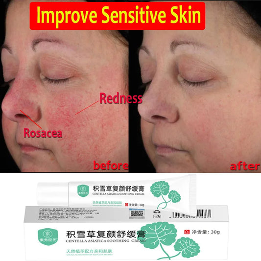 Redness Repair Cream for Face 5pcs - Rosacea, Acne, Sensitive, Dry Skin, Moisturizing, Soothing, K-Beauty