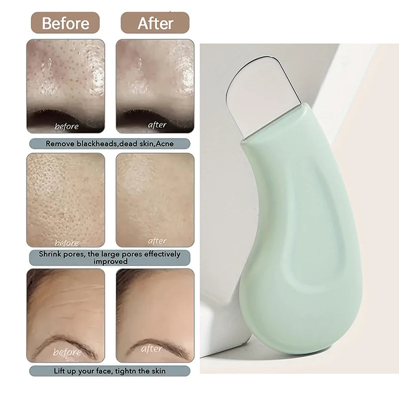 Outil Retrait Points Noirs Professionnel - Extracteur Comédons Nez Visage Acier Inoxydable Soin Peau Beauté