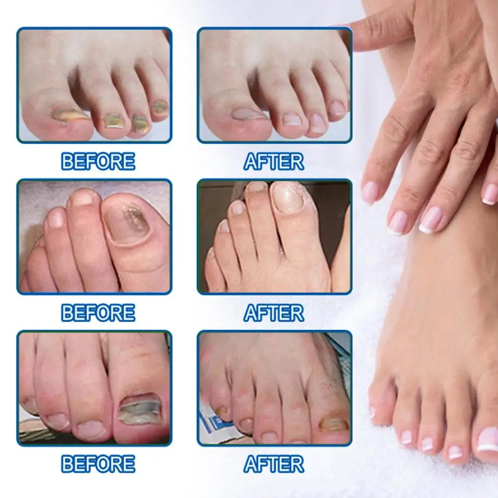 Sérum Réparateur Ongles 7 Jours – Anti-Fongique, Onychomycose & Ongles Incarnés