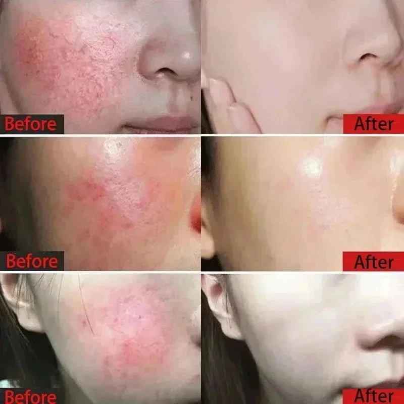 Crème Réparatrice Rougeurs Visage 5pcs - Rosacée Acné Peau Sensible Sèche Hydratante Apaisante K-Beauty