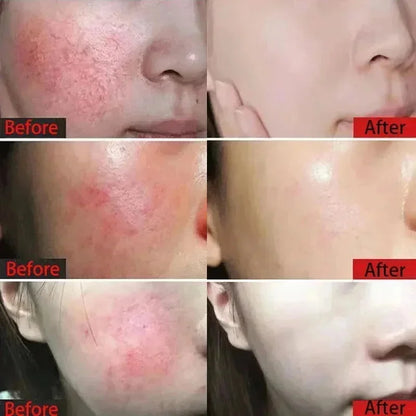 Crème Réparatrice Rougeurs Visage 5pcs - Rosacée Acné Peau Sensible Sèche Hydratante Apaisante K-Beauty