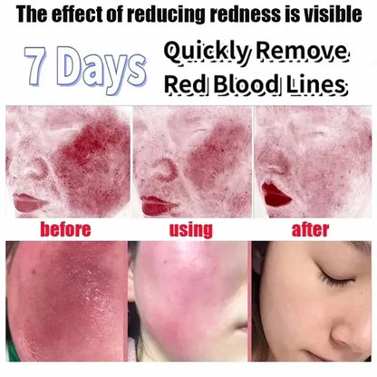 Crème Réparatrice Rougeurs Visage 5pcs - Rosacée Acné Peau Sensible Sèche Hydratante Apaisante K-Beauty