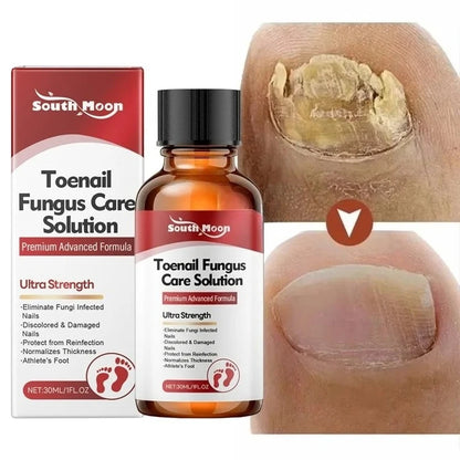 Sérum Traitement Antifongique pour Ongles – Huile Réparatrice Anti-Infection