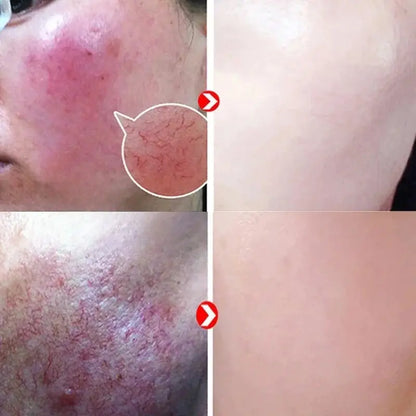 Crème Réparatrice Rougeurs Visage 5pcs - Rosacée Acné Peau Sensible Sèche Hydratante Apaisante K-Beauty