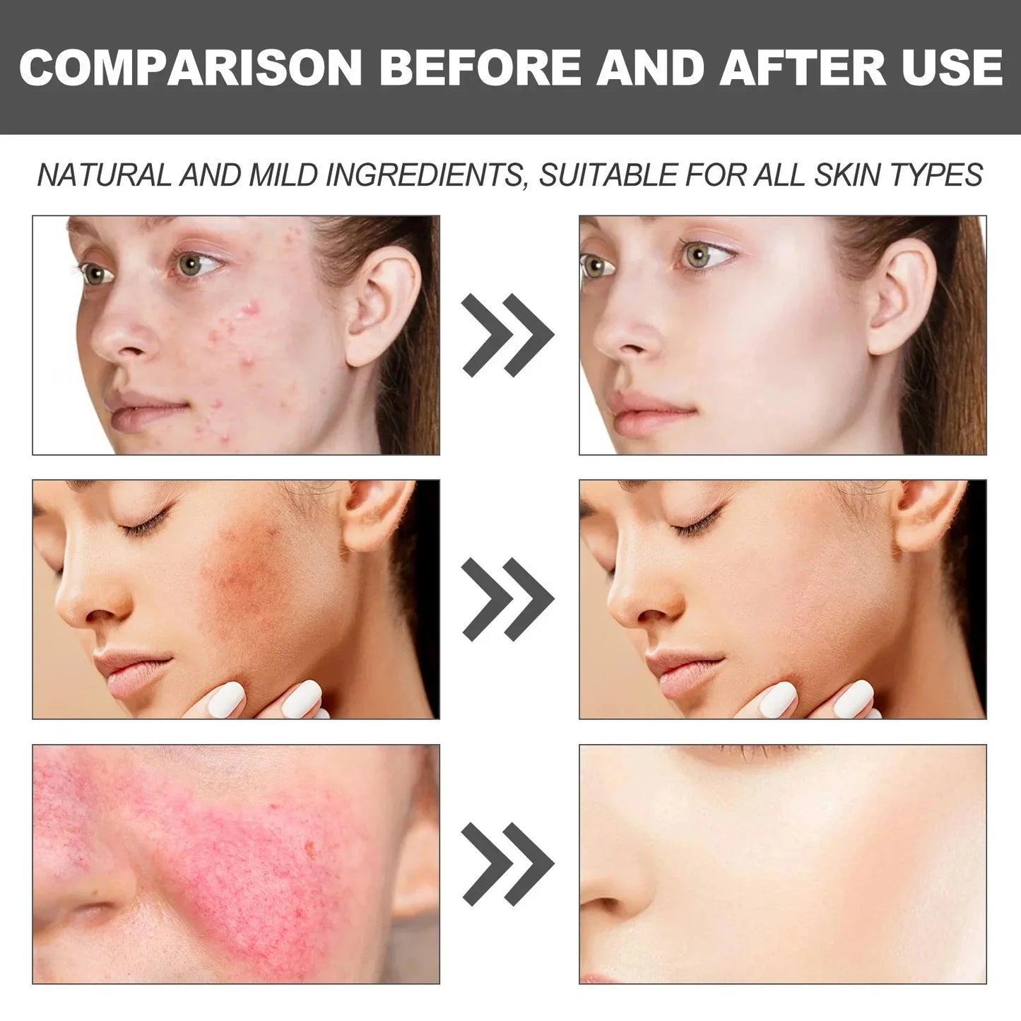 Crème Réparatrice Rougeurs Visage 5pcs - Rosacée Acné Peau Sensible Sèche Hydratante Apaisante K-Beauty