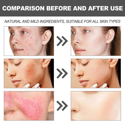 Crème Réparatrice Rougeurs Visage 5pcs - Rosacée Acné Peau Sensible Sèche Hydratante Apaisante K-Beauty