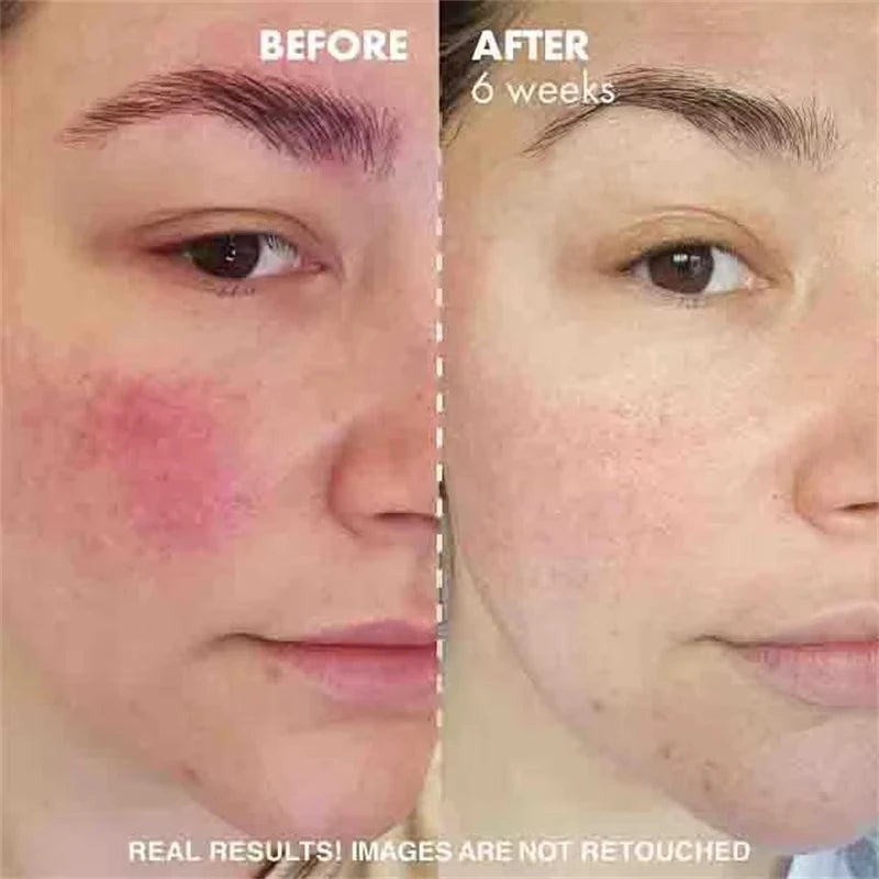 Crème Réparatrice Rougeurs Visage 5pcs - Rosacée Acné Peau Sensible Sèche Hydratante Apaisante K-Beauty