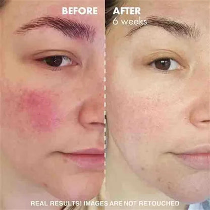 Crème Réparatrice Rougeurs Visage 5pcs - Rosacée Acné Peau Sensible Sèche Hydratante Apaisante K-Beauty