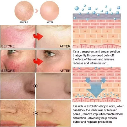 Crème Réparatrice Rougeurs Visage 5pcs - Rosacée Acné Peau Sensible Sèche Hydratante Apaisante K-Beauty