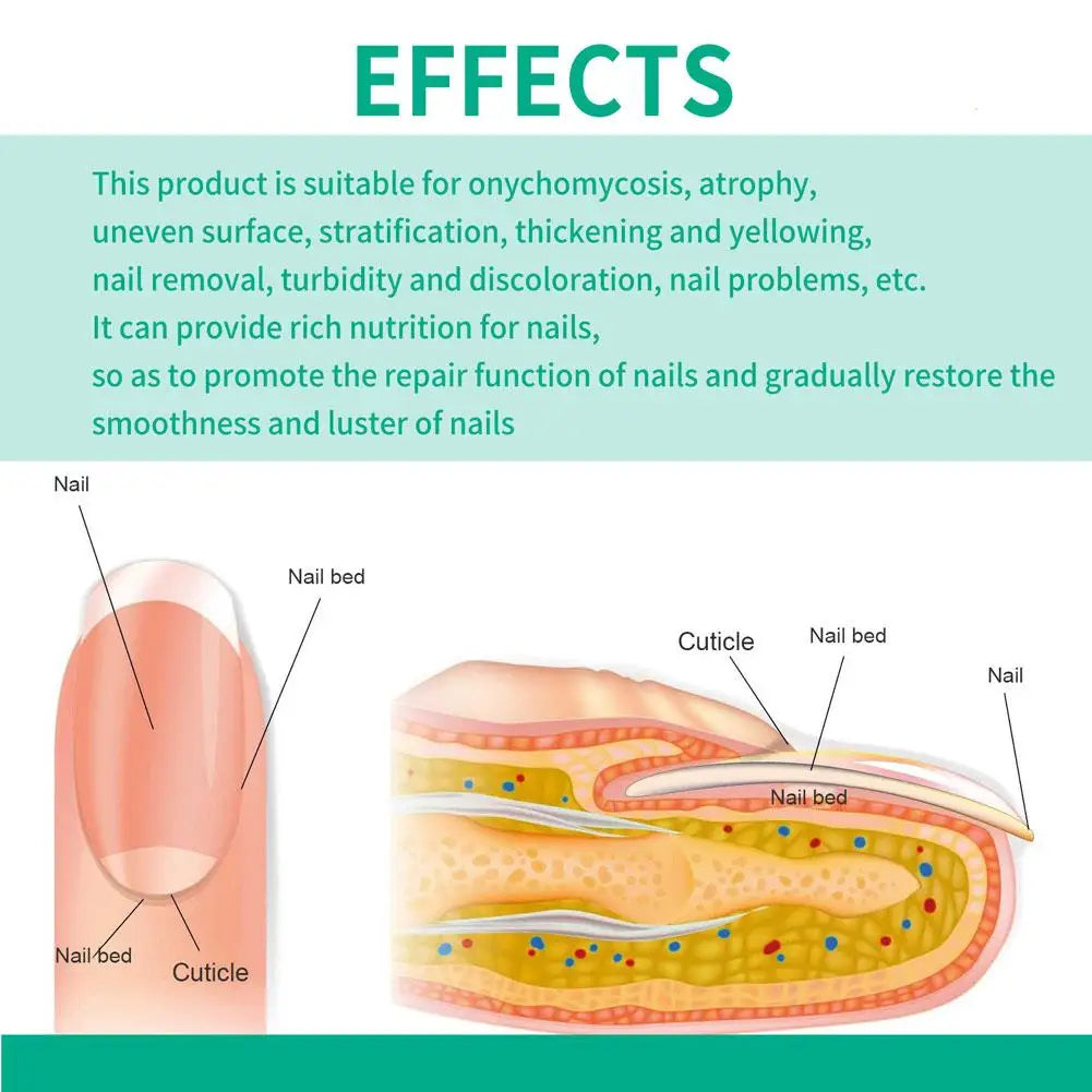 Sérum Anti-Fongique pour Ongles 10ml – Traitement Onychomycose & Paronychie