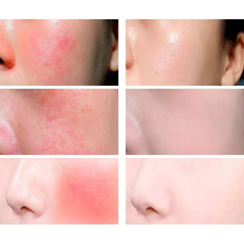 Crème Réparatrice Rougeurs Visage 5pcs - Rosacée Acné Peau Sensible Sèche Hydratante Apaisante K-Beauty