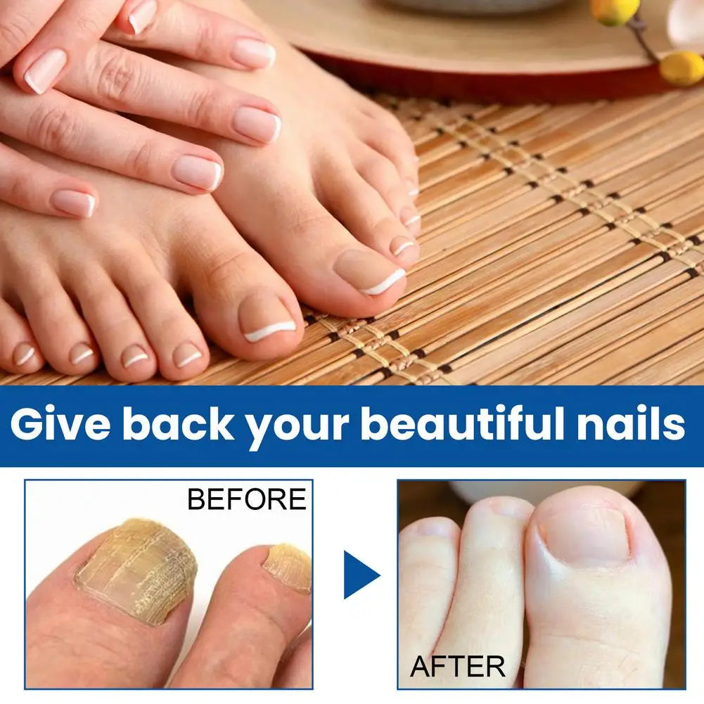 Sérum Réparateur Ongles 7 Jours – Anti-Fongique, Onychomycose & Ongles Incarnés