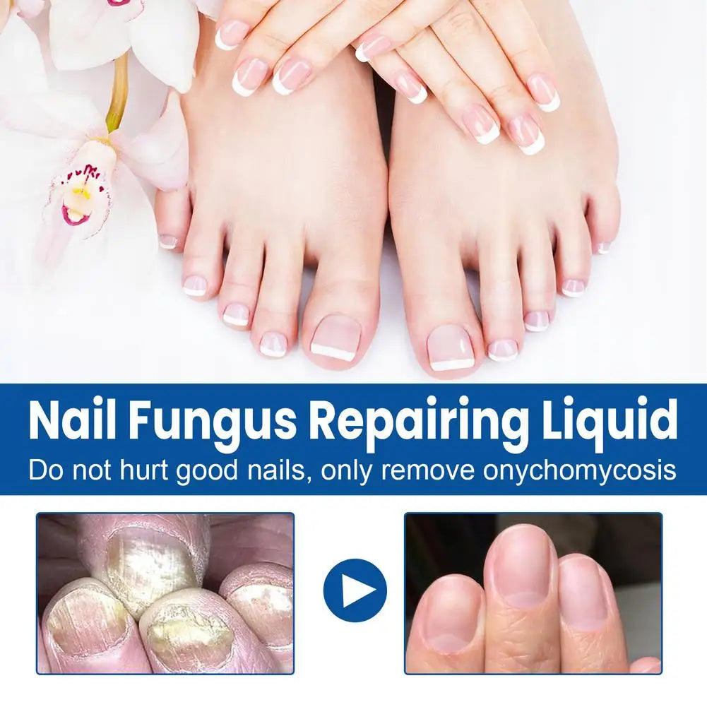 Sérum Réparateur Ongles 7 Jours – Anti-Fongique, Onychomycose & Ongles Incarnés
