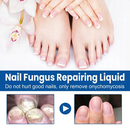 Sérum Réparateur Ongles 7 Jours – Anti-Fongique, Onychomycose & Ongles Incarnés