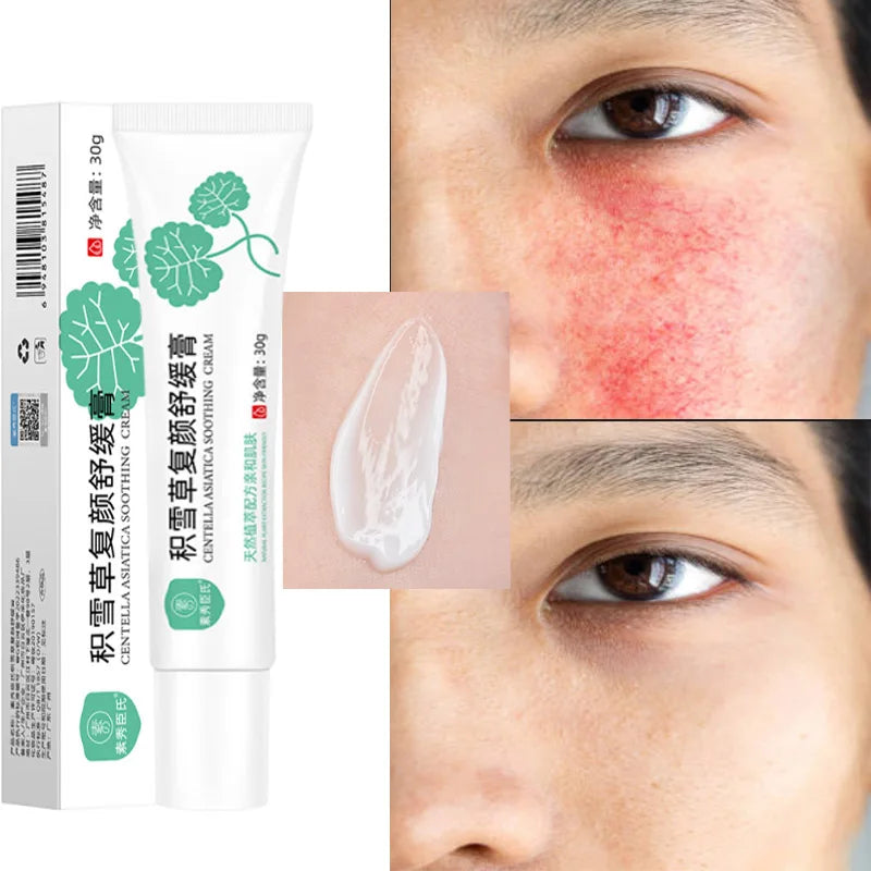 Crème Réparatrice Rougeurs Visage 5pcs - Rosacée Acné Peau Sensible Sèche Hydratante Apaisante K-Beauty